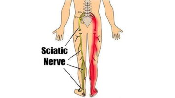 Read more about the article Sciatica osteopathy pain treatment
