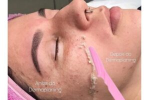 Read more about the article Dermaplaning For Skin